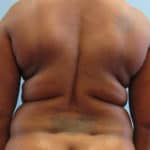 BEFORE back fat removal