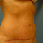 AFTER liposuction