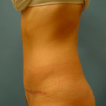 AFTER liposuction