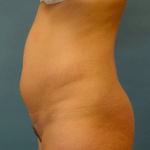 BEFORE liposuction