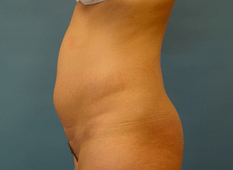 BEFORE liposuction