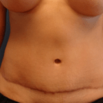 AFTER tummy tuck