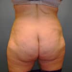 AFTER back fat removal