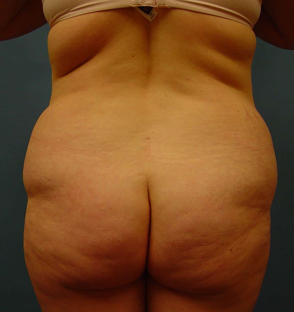 BEFORE back fat removal