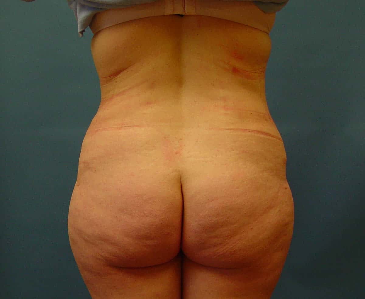 AFTER back fat removal