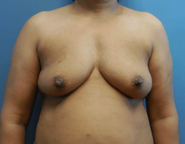 breast augmentation surgery milwaukee
