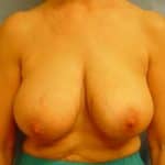 breast lift brookfield