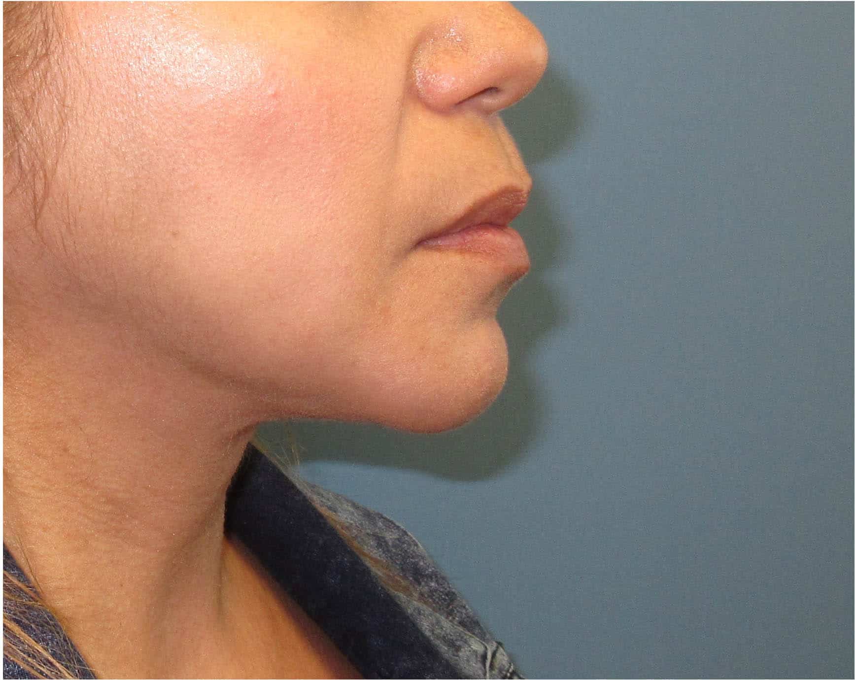 AFTER chin fat removal