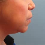 BEFORE chin fat removal