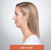 BEFORE chin fat removal