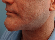 chin fat removal