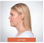 AFTER chin fat removal