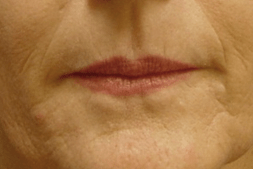 BEFORE lip filler treatment