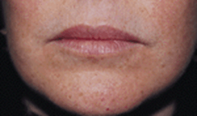 BEFORE lip filler injection