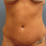 AFTER tummy tuck