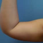 arm fat removal
