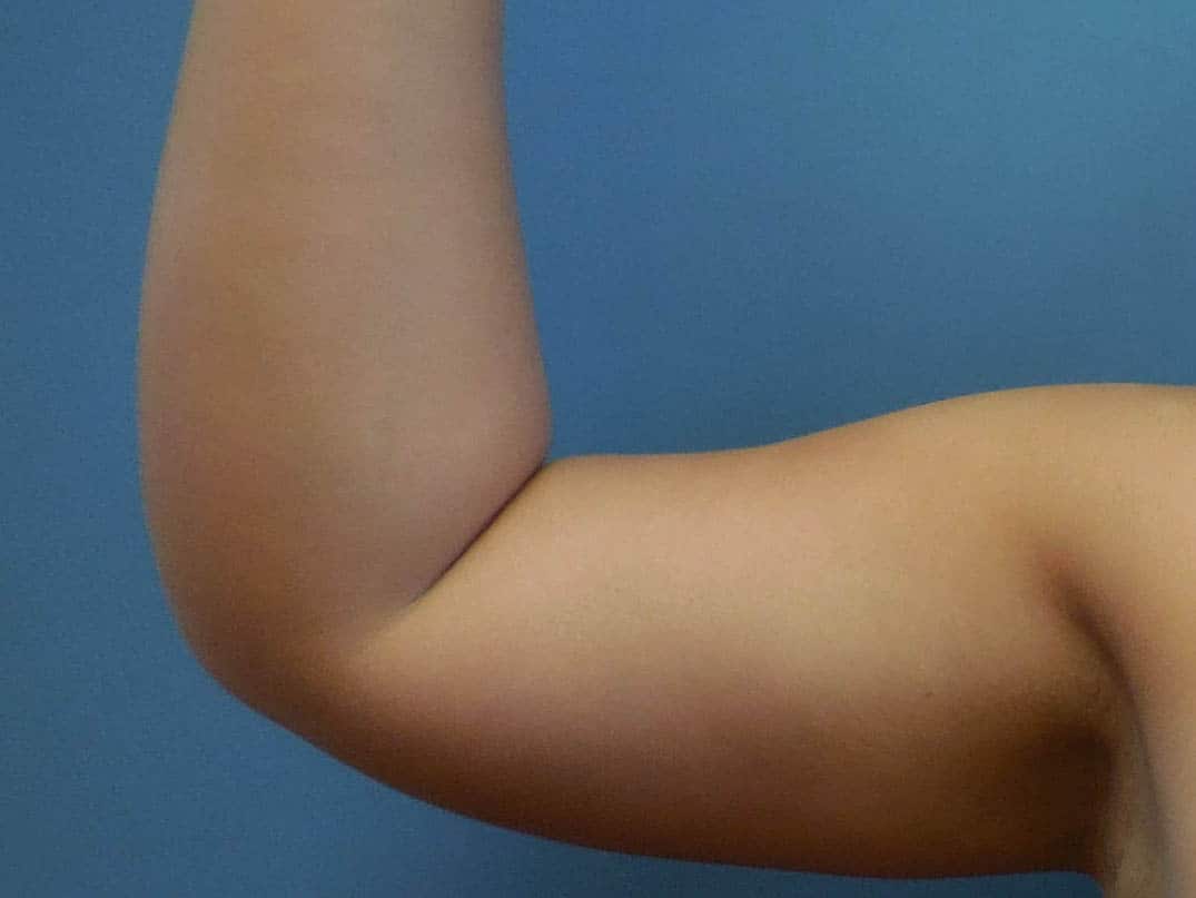 arm fat removal