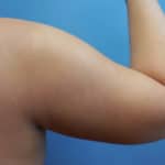 Upper arm fat removal