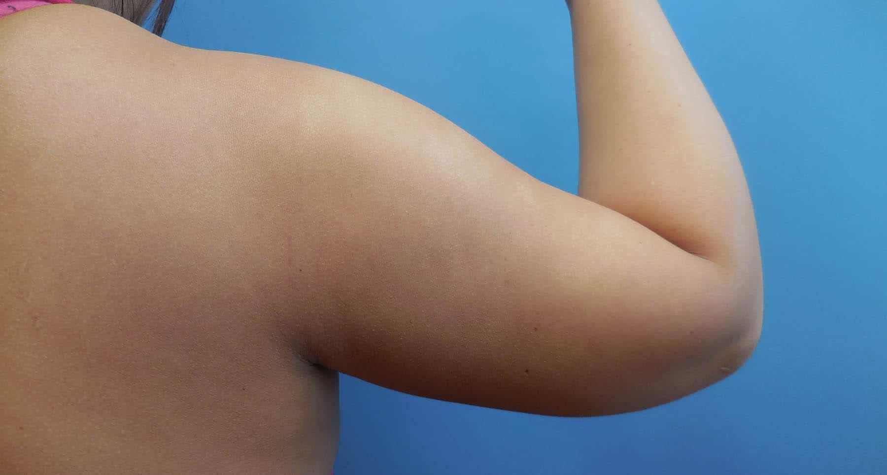 Upper arm fat removal