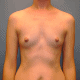 breast augmentation milwaukee