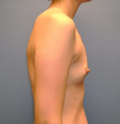 breast augmentation milwaukee