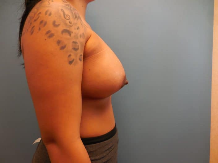 breast implants milwaukee