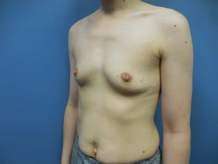 breast enlargement