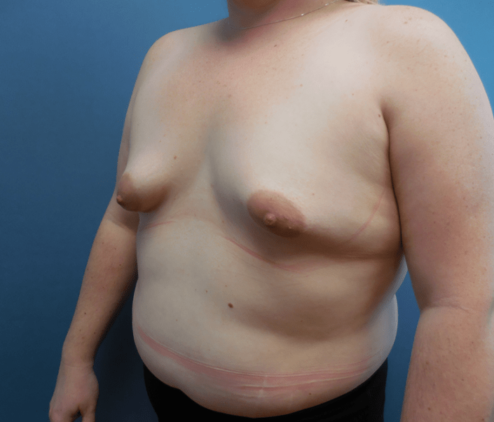 liposuction milwaukee
