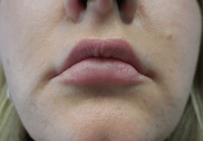 botox lips