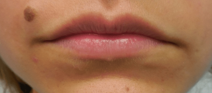 lip filler before pic