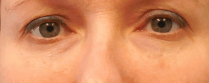 eyelid plastic surgery