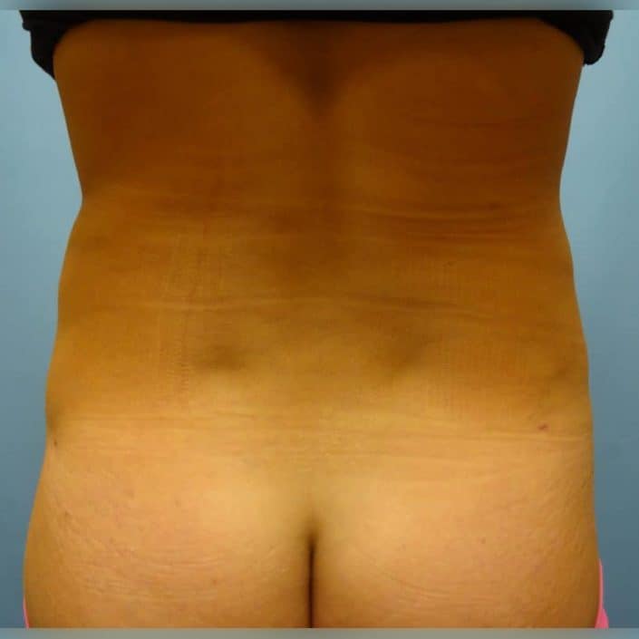 back fat removal