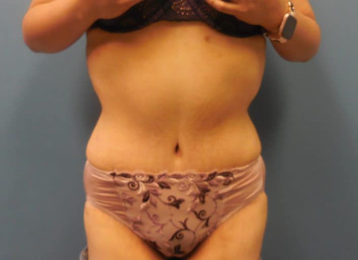 liposuction after pic