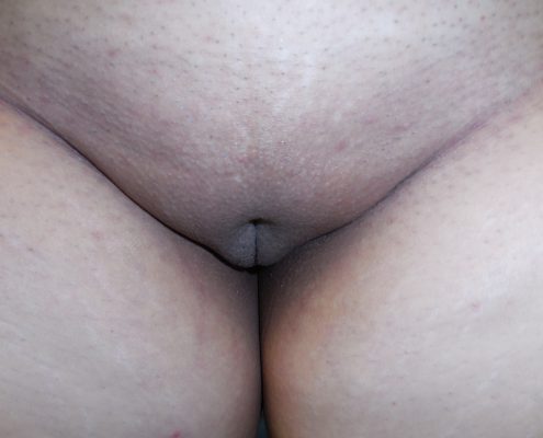 after labiaplasty pic