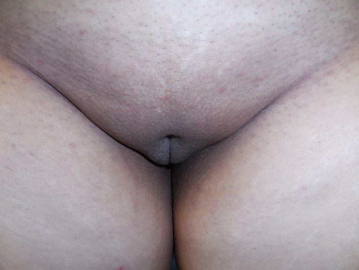 after labiaplasty pic