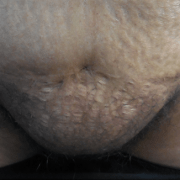 female pubic liposuction: before