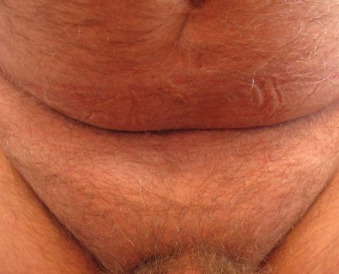 male pubic liposuction