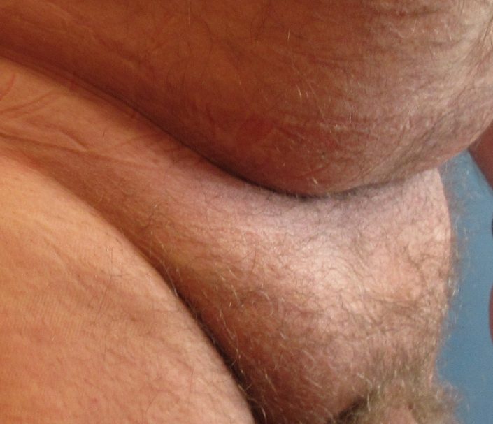 before pubic fat removal pic: male