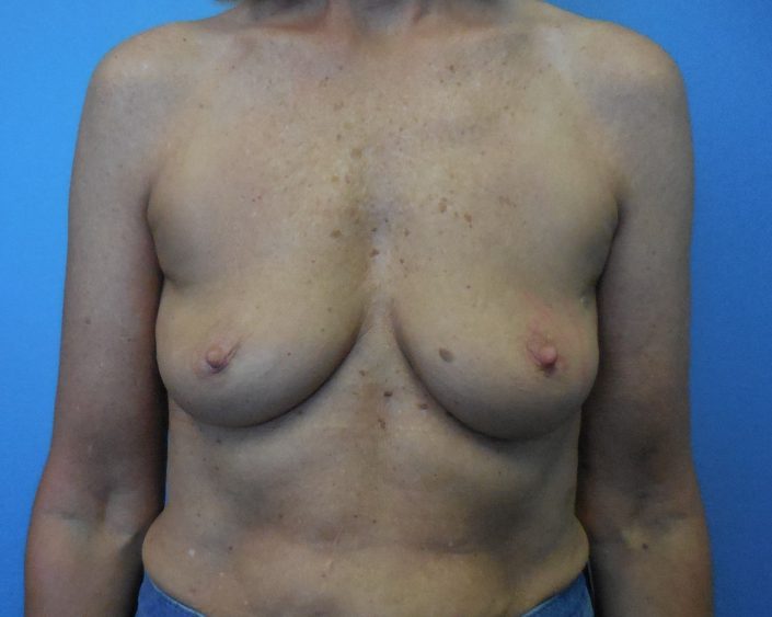 before breast implants